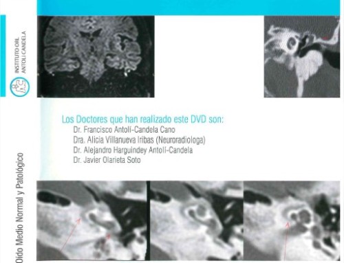 Radiología Oído Medio Normal y Patológico